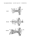 Ostomy Appliance diagram and image