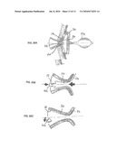 Ostomy Appliance diagram and image