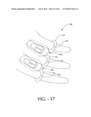 DISTRACTIBLE INTERSPINOUS PROCESS IMPLANT AND METHOD OF IMPLANTATION diagram and image
