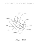 DISTRACTIBLE INTERSPINOUS PROCESS IMPLANT AND METHOD OF IMPLANTATION diagram and image