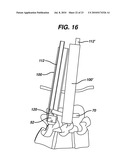 METHODS AND DEVICES FOR MINIMALLY INVASIVE SPINAL FIXATION ELEMENT PLACEMENT diagram and image
