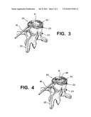 Method and compostion for repair and reconstruction of intervertebral discs and other reconstructive surgery diagram and image