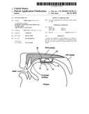 PALATAL IMPLANT diagram and image