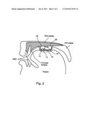 PALATAL IMPLANT diagram and image