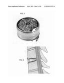 DYNAMIC SPINAL IMPLANTS INCORPORATING CARTILAGE BEARING GRAFT MATERIAL diagram and image
