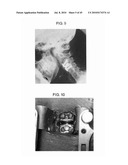 DYNAMIC SPINAL IMPLANTS INCORPORATING CARTILAGE BEARING GRAFT MATERIAL diagram and image