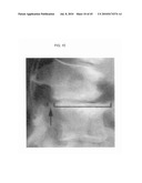 DYNAMIC SPINAL IMPLANTS INCORPORATING CARTILAGE BEARING GRAFT MATERIAL diagram and image