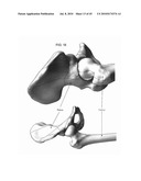 DYNAMIC SPINAL IMPLANTS INCORPORATING CARTILAGE BEARING GRAFT MATERIAL diagram and image