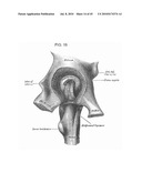 DYNAMIC SPINAL IMPLANTS INCORPORATING CARTILAGE BEARING GRAFT MATERIAL diagram and image