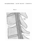 DYNAMIC SPINAL IMPLANTS INCORPORATING CARTILAGE BEARING GRAFT MATERIAL diagram and image