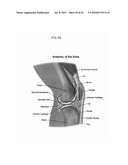 DYNAMIC SPINAL IMPLANTS INCORPORATING CARTILAGE BEARING GRAFT MATERIAL diagram and image