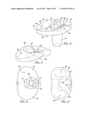 Knee Joint Prosthesis System and Method for Implantation diagram and image