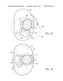 Knee Joint Prosthesis System and Method for Implantation diagram and image