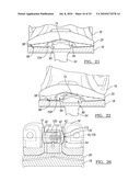 Knee Joint Prosthesis System and Method for Implantation diagram and image