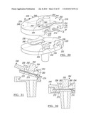 Knee Joint Prosthesis System and Method for Implantation diagram and image