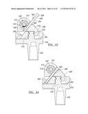 Knee Joint Prosthesis System and Method for Implantation diagram and image