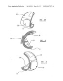 KNEE PROSTHESES diagram and image