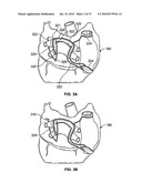 METHOD AND DEVICES FOR PERFORMING BIATRIAL COAGULATION diagram and image