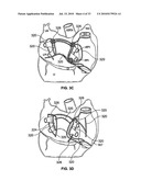 METHOD AND DEVICES FOR PERFORMING BIATRIAL COAGULATION diagram and image