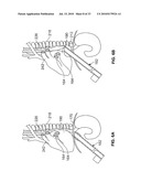 METHOD AND DEVICES FOR PERFORMING BIATRIAL COAGULATION diagram and image