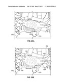 METHOD AND DEVICES FOR PERFORMING BIATRIAL COAGULATION diagram and image