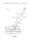 CLOSURE DEVICES, SYSTEMS, AND METHODS diagram and image