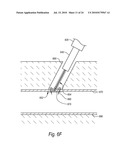 CLOSURE DEVICES, SYSTEMS, AND METHODS diagram and image