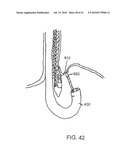 Methods for the Surgical Application of a Fastener and the Endoluminal Treatment of Gastroesophageal Reflux Disease (GERD) diagram and image