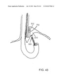 Methods for the Surgical Application of a Fastener and the Endoluminal Treatment of Gastroesophageal Reflux Disease (GERD) diagram and image