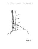 Methods for the Surgical Application of a Fastener and the Endoluminal Treatment of Gastroesophageal Reflux Disease (GERD) diagram and image