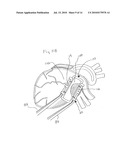 APPARATUS AND METHODS FOR DEPLOYING A CLIP TO OCCLUDE AN ANATOMICAL STRUCTURE diagram and image