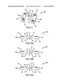 METHOD AND APPARATUS FOR BONE FRACTURE FIXATION diagram and image