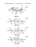 METHOD AND APPARATUS FOR BONE FRACTURE FIXATION diagram and image