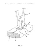 METHOD AND APPARATUS FOR BONE FRACTURE FIXATION diagram and image