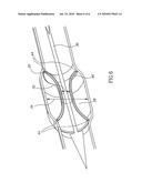 DEVICE AND METHOD FOR TREATING ISCHEMIC HEART DISEASE diagram and image