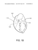 DEVICES AND METHODS FOR ASSISTING HEART FUNCTION diagram and image