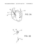 DEVICES AND METHODS FOR ASSISTING HEART FUNCTION diagram and image