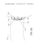 DEVICES AND METHODS FOR ASSISTING HEART FUNCTION diagram and image