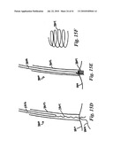 DEVICES AND METHODS FOR ASSISTING HEART FUNCTION diagram and image