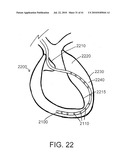 DEVICES AND METHODS FOR ASSISTING HEART FUNCTION diagram and image