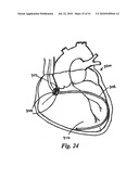 DEVICES AND METHODS FOR ASSISTING HEART FUNCTION diagram and image