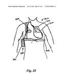 DEVICES AND METHODS FOR ASSISTING HEART FUNCTION diagram and image