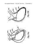 DEVICES AND METHODS FOR ASSISTING HEART FUNCTION diagram and image