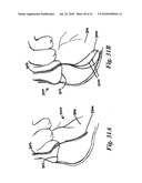 DEVICES AND METHODS FOR ASSISTING HEART FUNCTION diagram and image