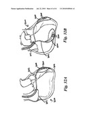 DEVICES AND METHODS FOR ASSISTING HEART FUNCTION diagram and image