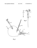 URETHRAL CATHETERLESS RADICAL PROSTATECTOMY diagram and image