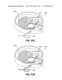 USER INTERFACE INDICATING FLUID LOCATION FOR AN IMPLANTABLE FLUID DELIVERY DEVICE diagram and image