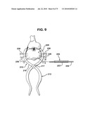 FEMORAL PROSTHETIC IMPLANT diagram and image