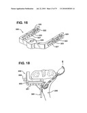 FEMORAL PROSTHETIC IMPLANT diagram and image