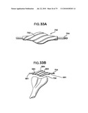 FEMORAL PROSTHETIC IMPLANT diagram and image